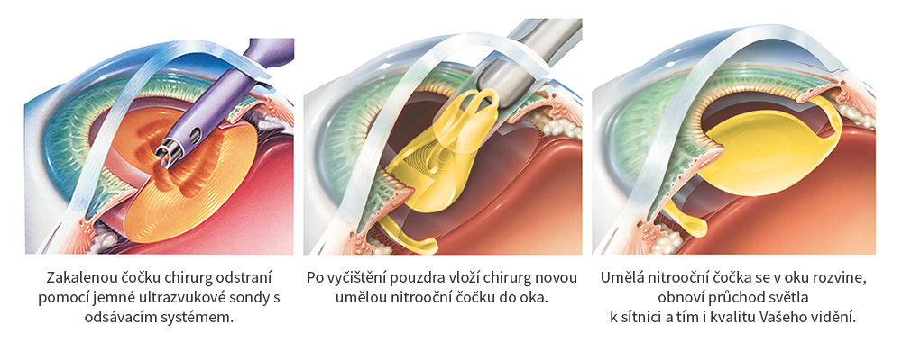 Nelaserová operace šedého zákalu - Operace katarakty v Hradeckém očním sanatoriu
