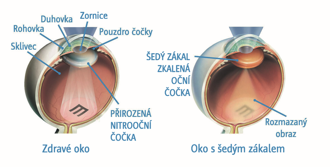 Jak působí šedý zákal na oční čočku