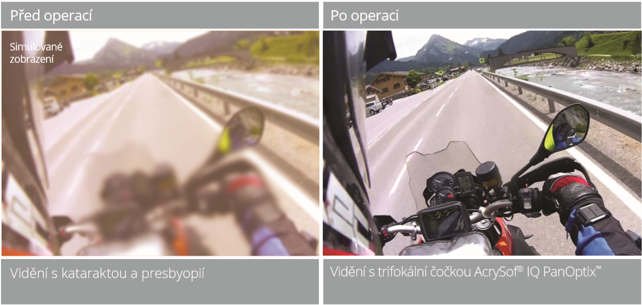 Výměna oční čočky způsobuje takto výrazné zlepšení vidění po operaci šedého zákalu a odstraňuje příznaky Výměna oční čočky způsobuje takto výrazné zlepšení vidění po operaci šedého zákalu a odstraňuje příznaky